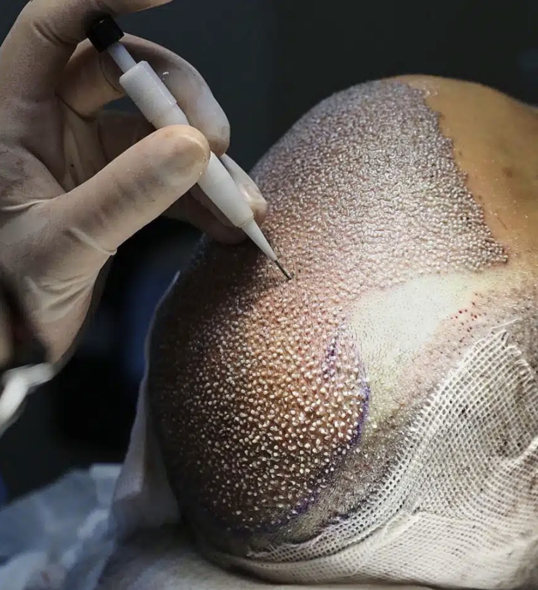 Técnica de implantación DHI durante un procedimiento capilar