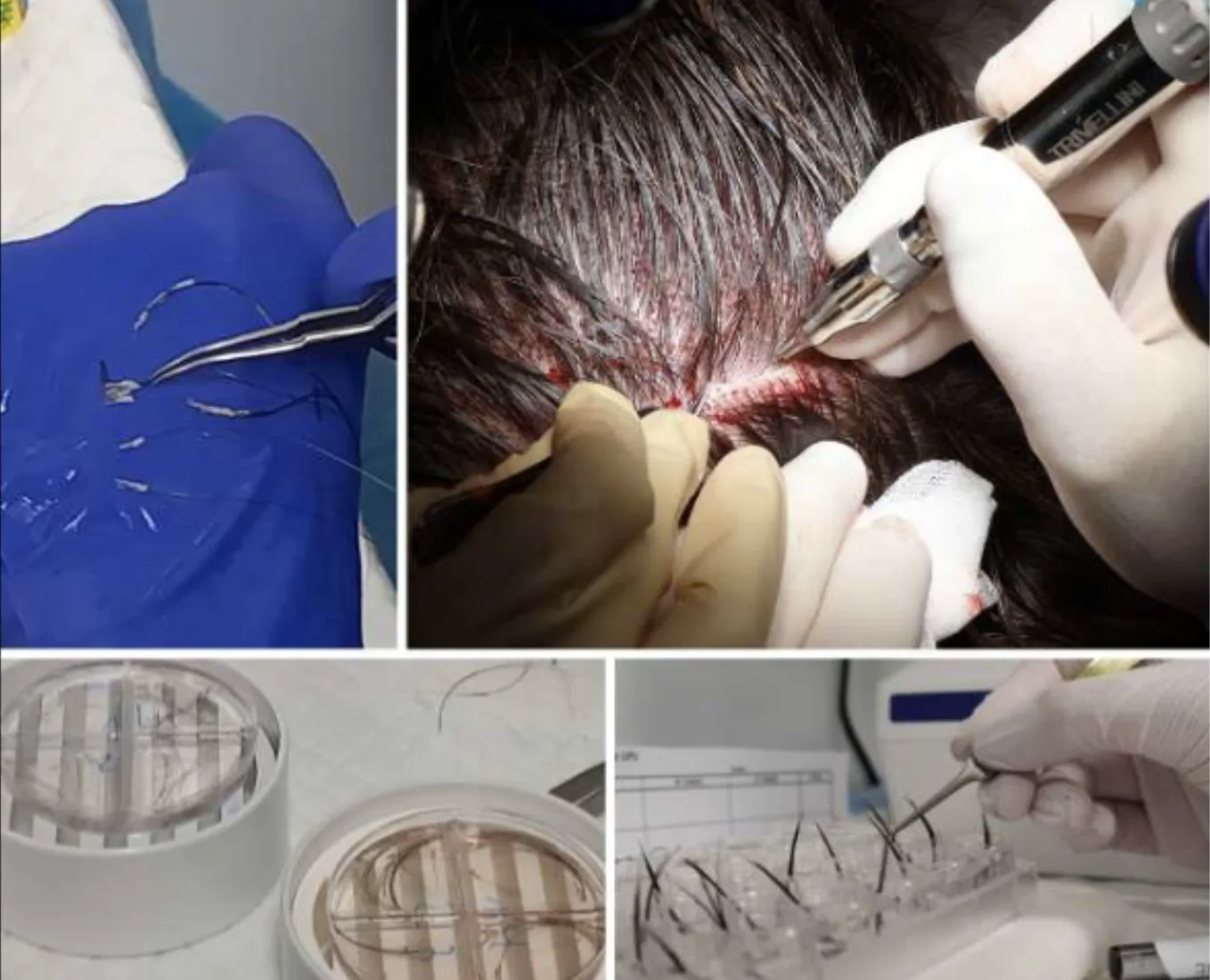 Procedimiento de trasplante capilar sin rapar mediante FUE Long Hair