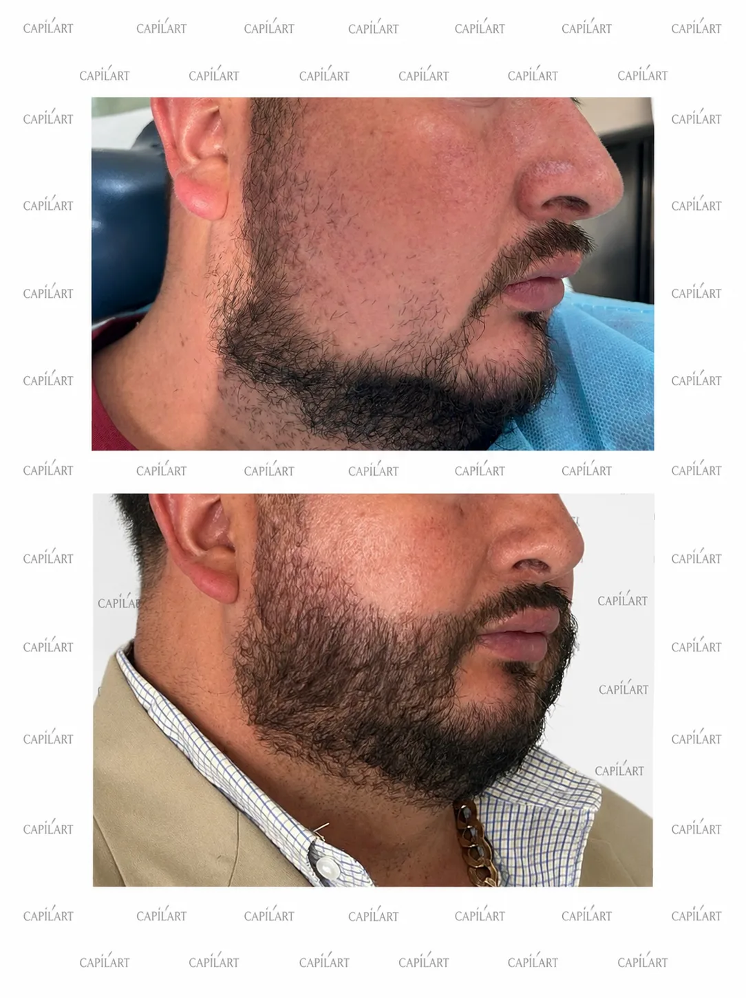 Resultados de trasplante capilar en barba en un paciente de CAPILART
